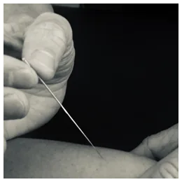 Kinesist plaatst een fijne naald in het onderbeen van een patiënt tijdens dry needling